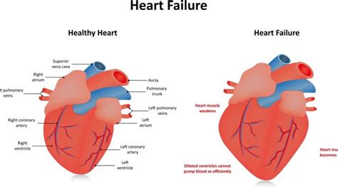 hypokinetic heart treatment.